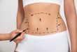 Liposuction Surgery in Dubai