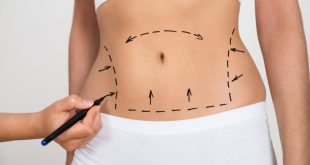 Liposuction Surgery in Dubai