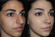 Rhinoplasty and the Impact of Weight Changes on Your Results