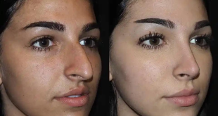 Rhinoplasty and the Impact of Weight Changes on Your Results