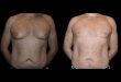 Before and After Male Breast Reduction Results