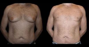 Before and After Male Breast Reduction Results