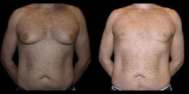 Before and After Male Breast Reduction Results