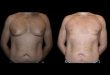 Before and After Male Breast Reduction Results