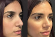 Will Rhinoplasty Improve My Self-Esteem?