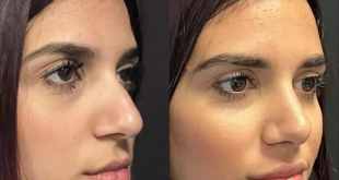 Will Rhinoplasty Improve My Self-Esteem?