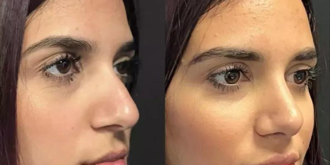 Will Rhinoplasty Improve My Self-Esteem?