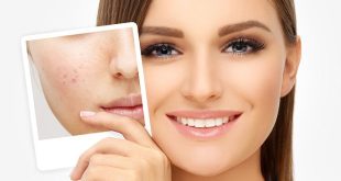 What is the best way to treat acne overnight?