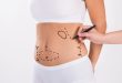 Everything You Need to Know About Liposuction in Dubai