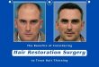 The-Benefits-of-Considering-Hair-Restoration-Surgery-to-Treat-Hair-Thinning