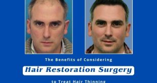 The-Benefits-of-Considering-Hair-Restoration-Surgery-to-Treat-Hair-Thinning