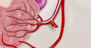 Prostate Artery Embolization