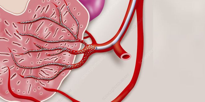 Prostate Artery Embolization