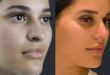 Rhinoplasty Expertise from the Best Doctors in Dubai