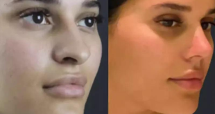 Rhinoplasty Expertise from the Best Doctors in Dubai